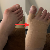 【距骨サロン日本橋店】症例紹介『外反母趾』