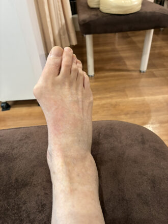 80代女性（郡山市）施術前