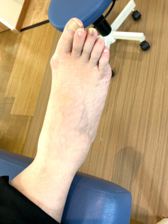 40代女性（練馬区）施術前