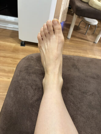 60代女性（福島市）施術前