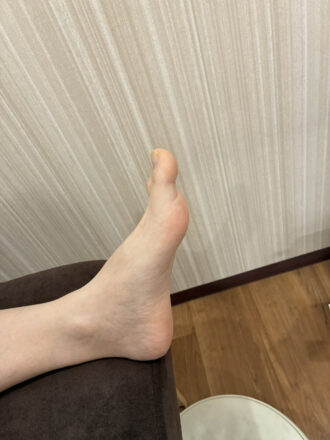 50代男性（郡山市）施術前