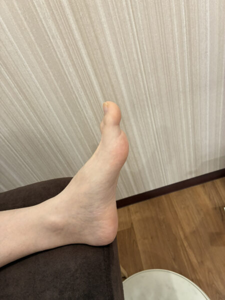 50代男性（郡山市）施術前