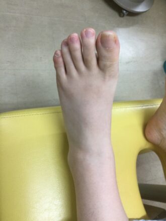 40代女性（八王子市）施術前