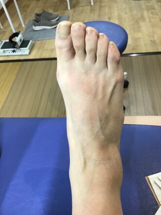 50代女性（練馬区）施術前