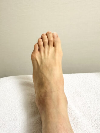 女性（代々木）施術前