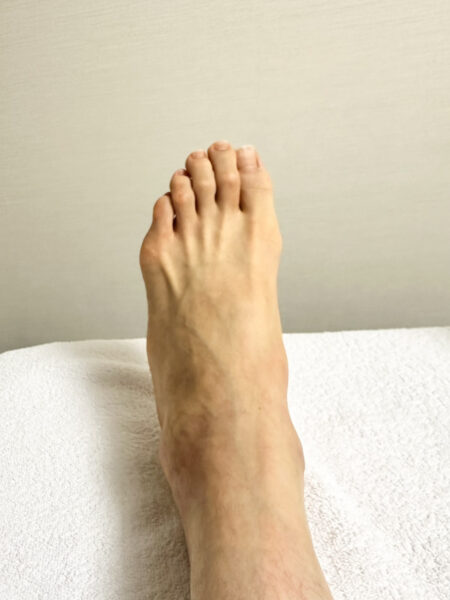 女性（代々木からお越しの方）施術前