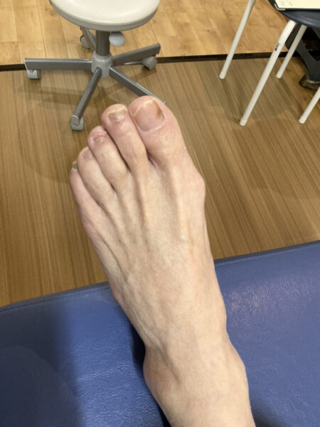 70代女性（練馬区からお越しの方）施術前