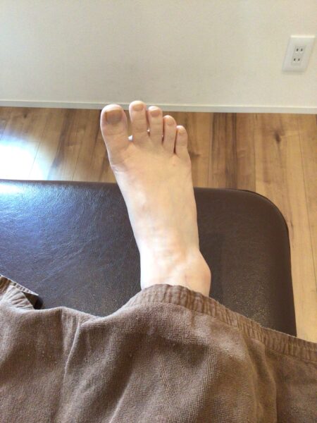 30代女性（古河市）施術前