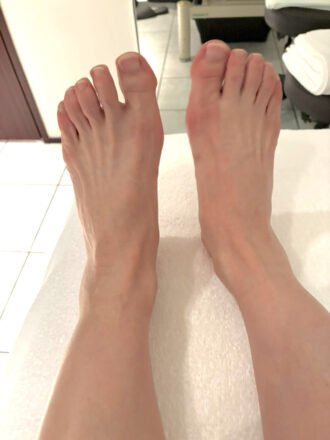 50代女性（赤坂）施術前