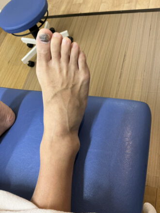 50代男性（練馬区）施術前