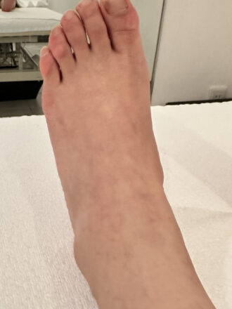 40代女性（浅草）施術前