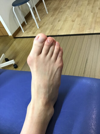 50代女性（練馬区）施術前