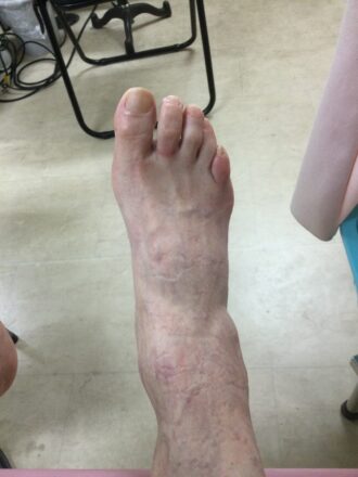 50代女性（八王子）施術前