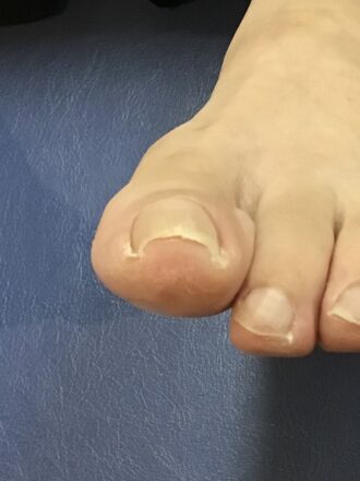 50代女性（練馬区）施術前