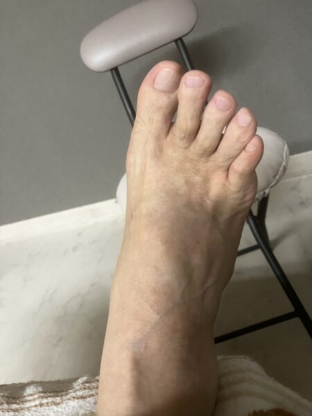 70代男性（小平市）施術前