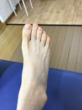 50代女性（練馬区）施術前