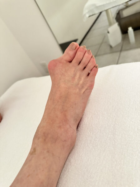 60代女性（千代田区）施術前