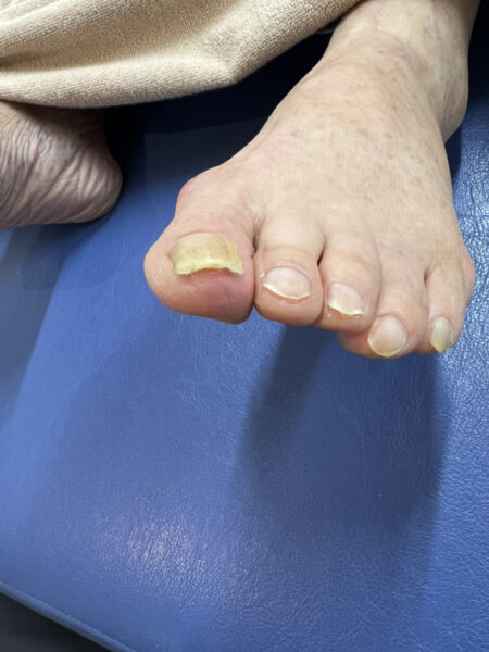 80代女性（練馬）施術後