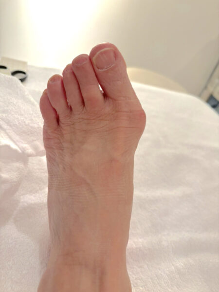 70代女性（千代田区）施術前