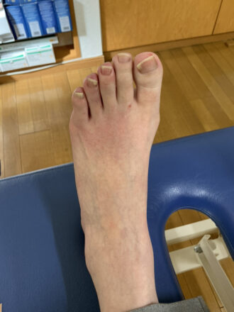 60代女性（練馬区）施術前