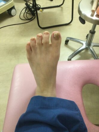 50代女性（八王子市）施術前