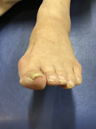 80代女性（練馬）施術前