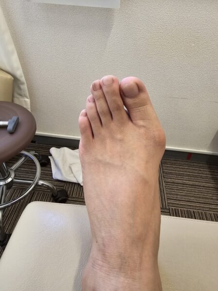 50代女性（熊本市）施術前