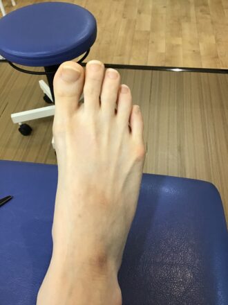 40代女性（練馬）施術前