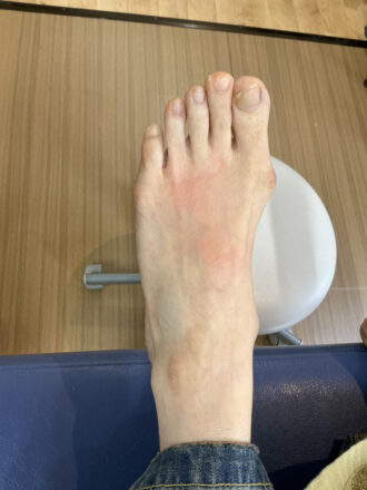 50代女性（練馬区）施術前