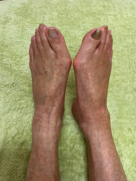 90代女性（西尾市）施術前