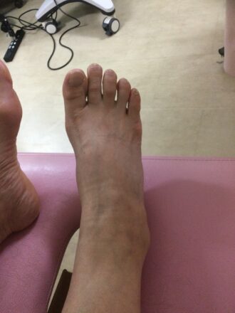 60代女性（八王子市）施術前