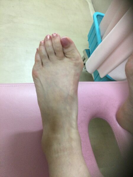 50代女性（八王子市）施術前