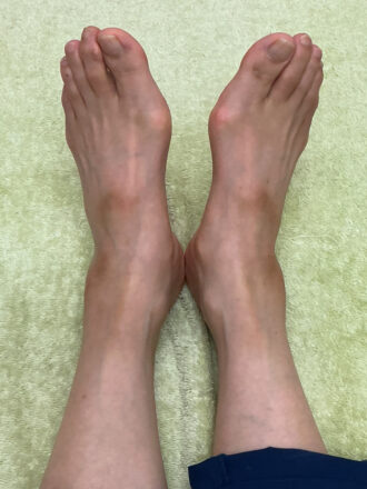 80代女性（西尾市）施術前