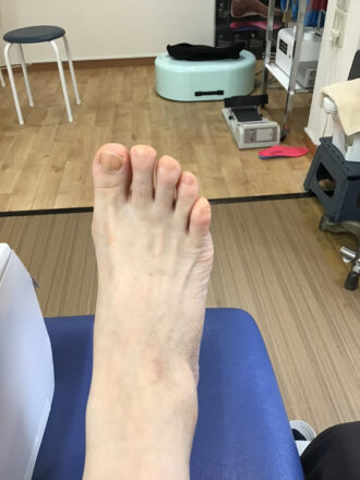 50代女性（練馬区）施術前