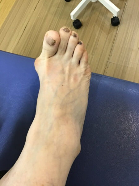 50代女性（練馬区からお越しの方）施術前