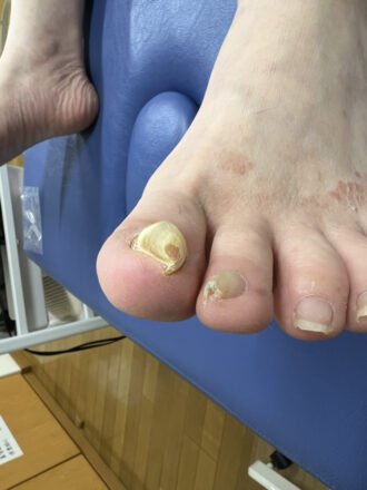 60代男性（練馬区）施術前